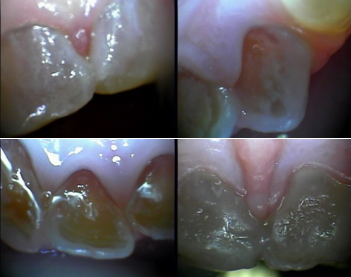 Dentinog Nese Imperfeita Associada Osteog Nese Imperfeita Docfy